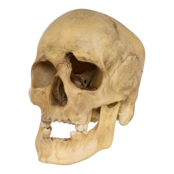 Replica Human Male with a 32-caliber Gunshot Wound Skull