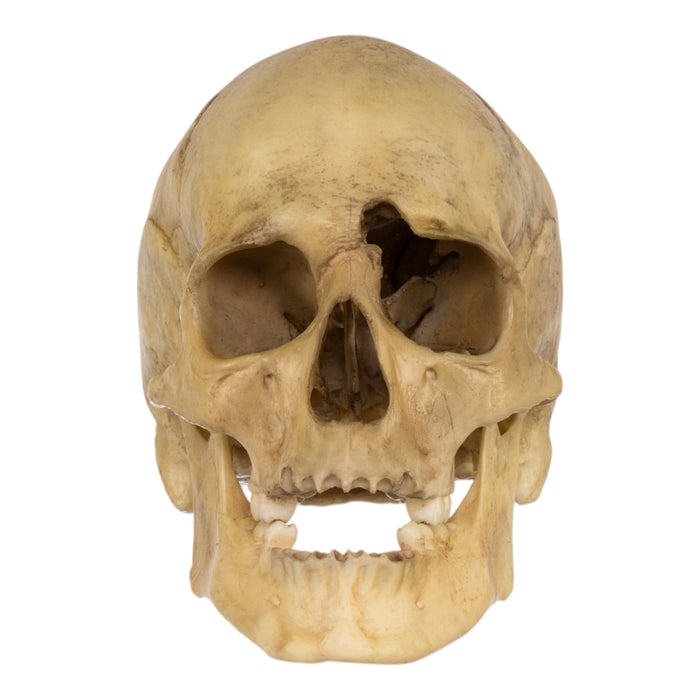 Replica Human Male with a 32-caliber Gunshot Wound Skull