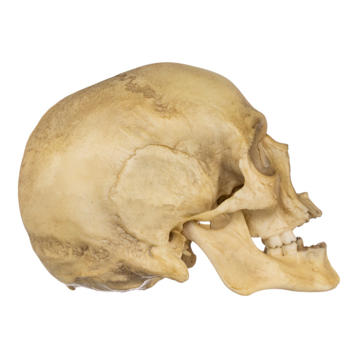 Replica Human Male with a 32-caliber Gunshot Wound Skull