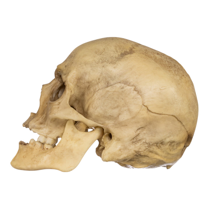 Replica Human Male with a 32-caliber Gunshot Wound Skull