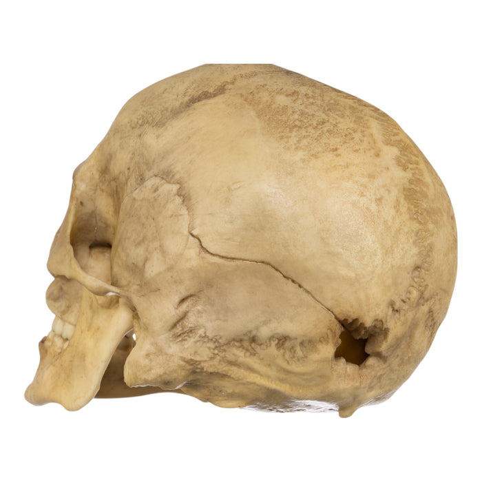 Replica Human Male with a 32-caliber Gunshot Wound Skull