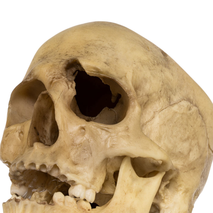 Replica Human Male with a 32-caliber Gunshot Wound Skull