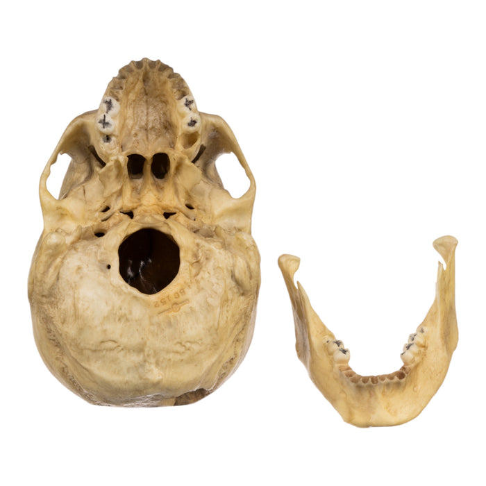 Replica Human Male with a 32-caliber Gunshot Wound Skull