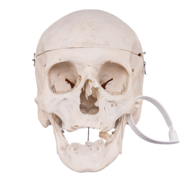 Real Human Skull - Pathology