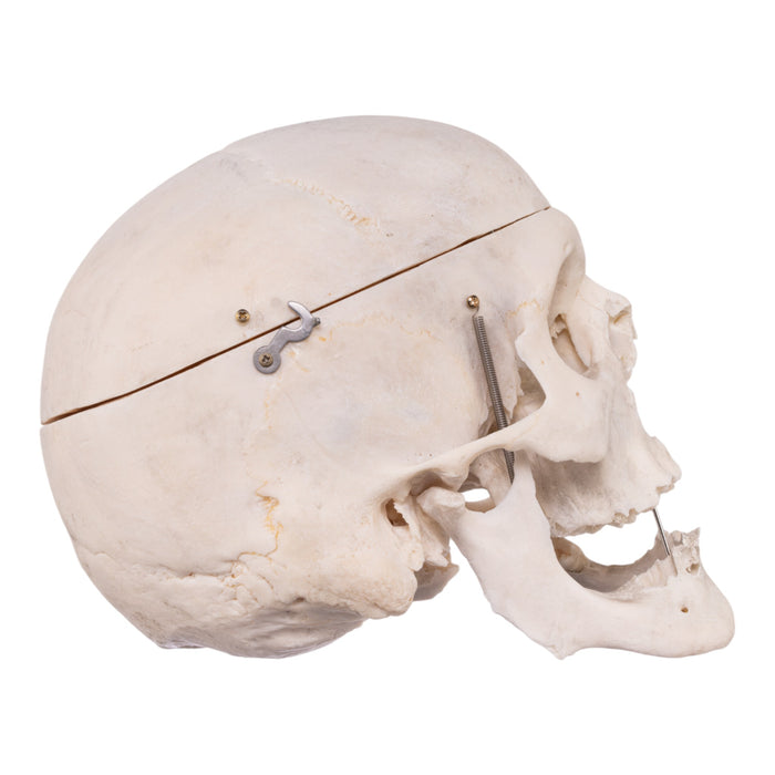 Real Human Skull - Pathology