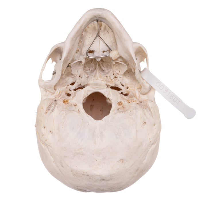 Real Human Skull - Pathology