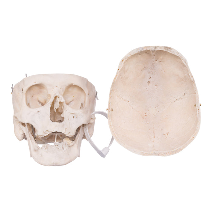 Real Human Skull - Pathology