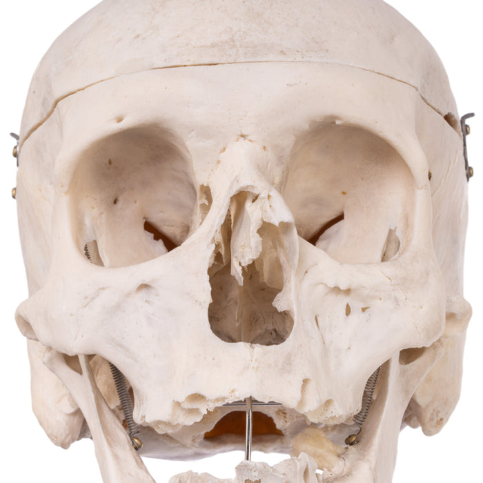 Real Human Skull - Pathology