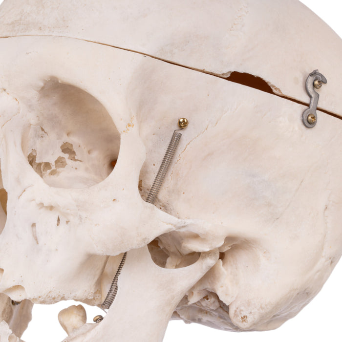 Real Human Skull - Pathology