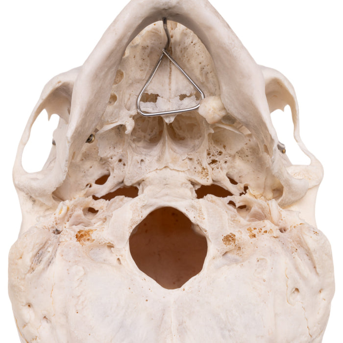 Real Human Skull - Pathology