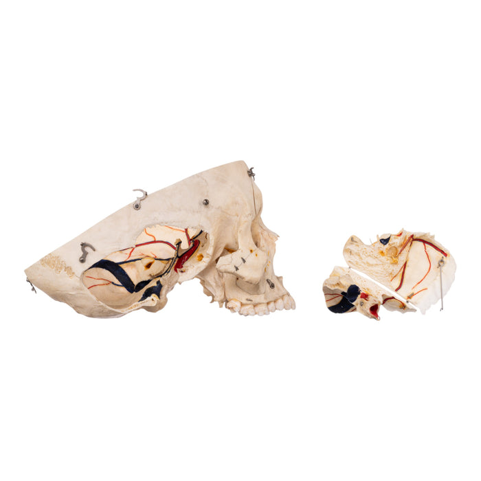 Real Human Dissected Skull with Carrying Case