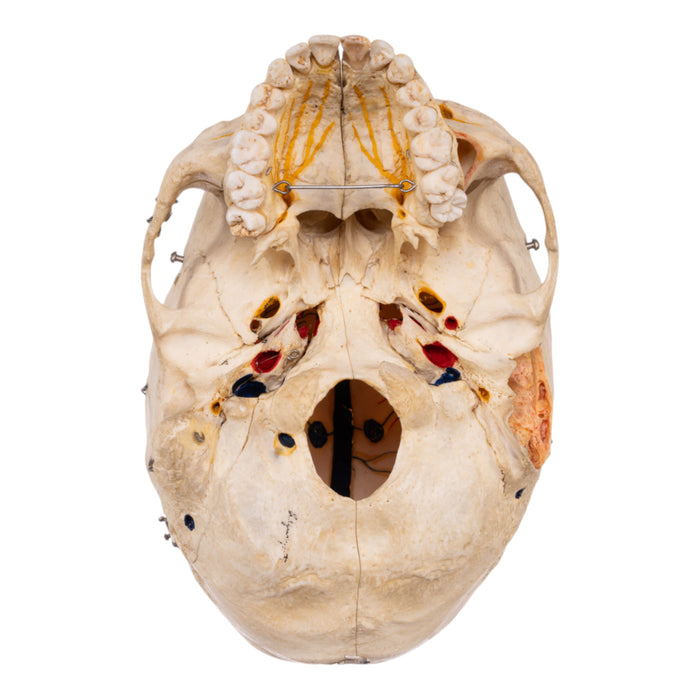 Real Human Dissected Skull with Carrying Case